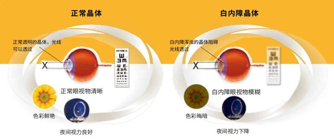 玻璃體混濁最新特效藥，突破與創(chuàng)新的治療策略